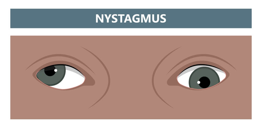 Nystagmus: Overview, Causes, Diagnosis, and Treatment