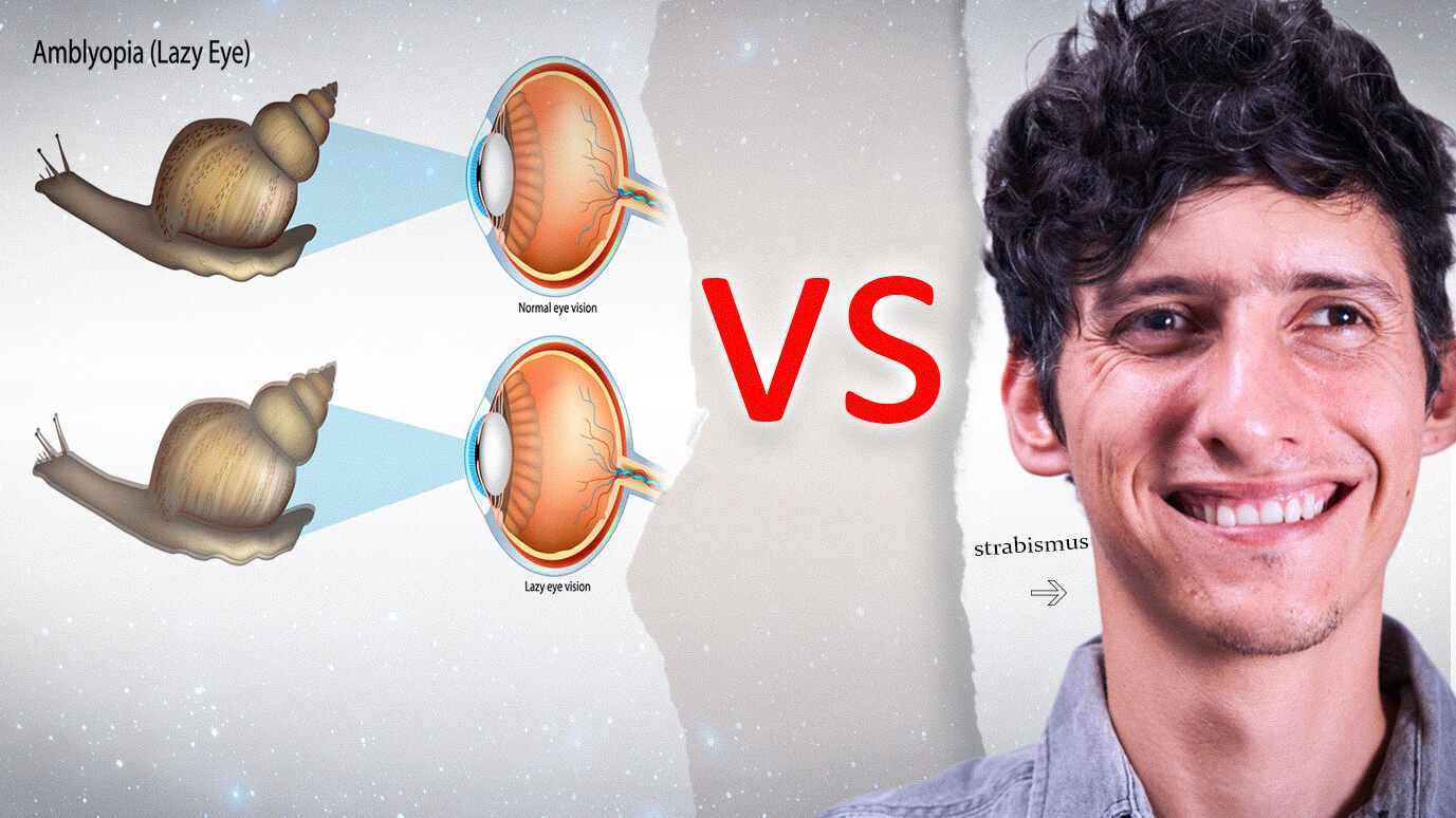 What is the difference between strabismus (Squint Eye) and Amblyopia (Lazy Eye)