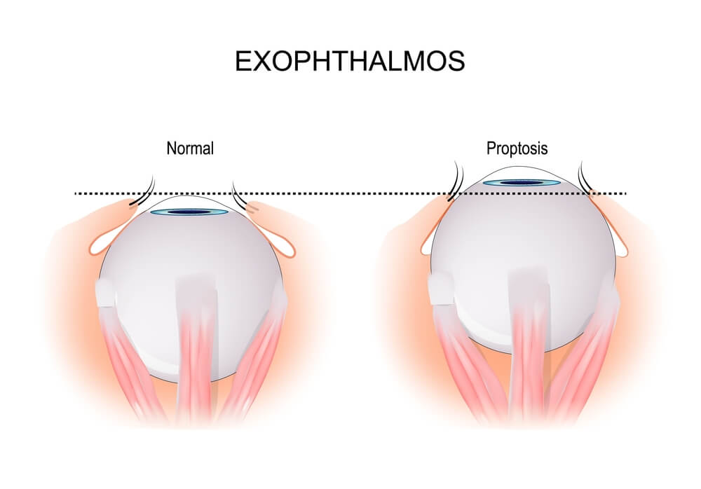 Understanding Exophthalmos: Key Causes and Effective Treatments