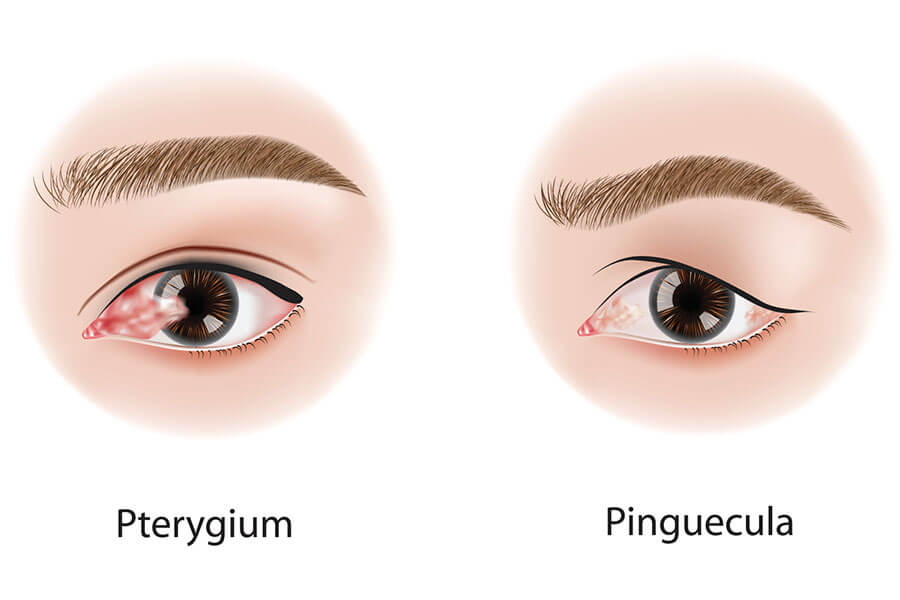 Differences, Causes, and Treatments for Pinguecula and Pterygium