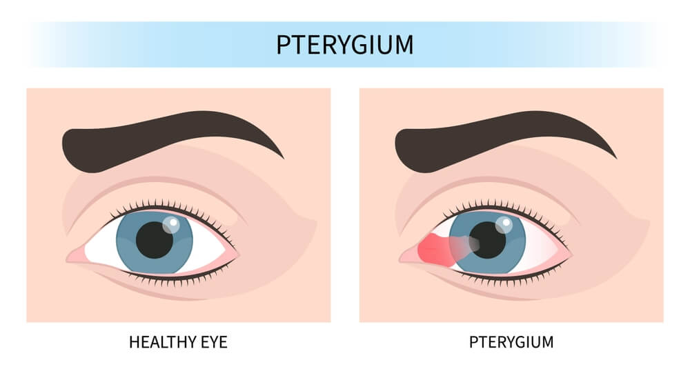 Understanding Eye Web (Pterygium): Find Effective Ways to Prevent and Treat It