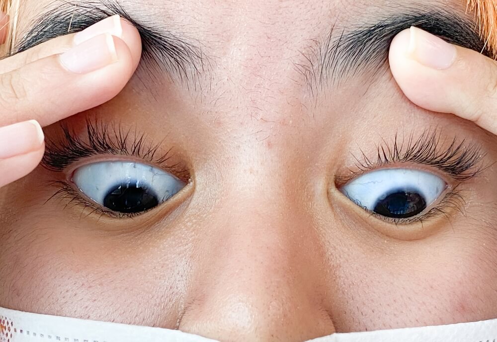 Blue Sclera: Causes, Risks, and Functions of the Black Sclera