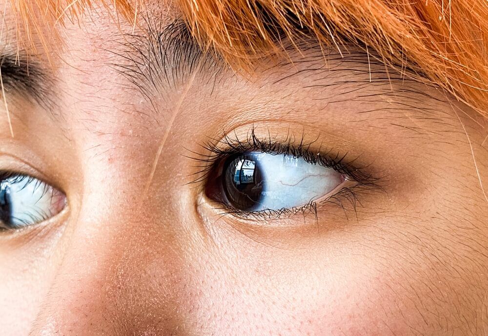 Blue Sclera: Causes, Risks, and Functions of the Sclera